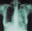 На Южном Урале ежегодно от туберкулеза умирает 500 человек