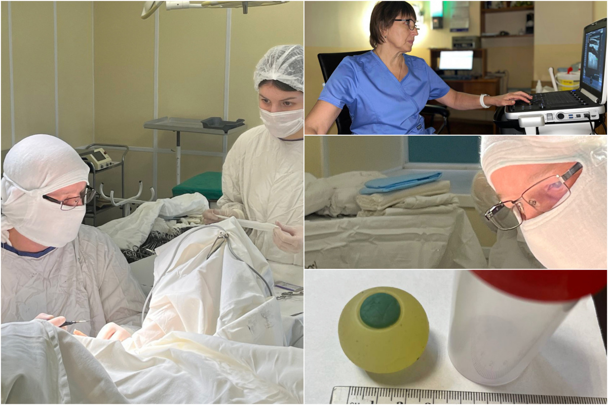 Челябинские хирурги нашли в кишечнике 9-летнего мальчика силиконовый глаз*