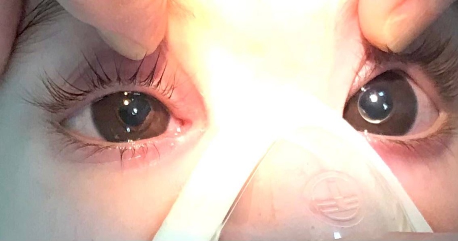 Челябинские врачи спасли зрение малышки с «выпавшими» хрусталиками глаз