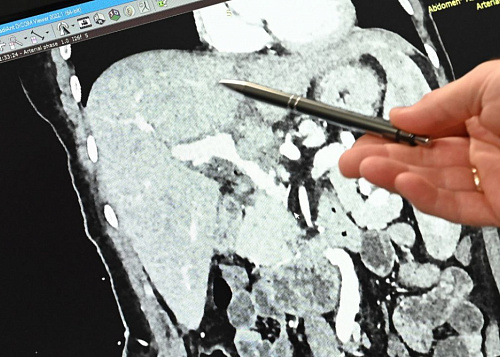 Как в Челябинской области организуют лечение от рака: путь от поликлиники до консилиума