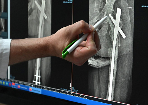 Гололёд и снегопады увеличили количество пациентов в травмцентре Челябинска